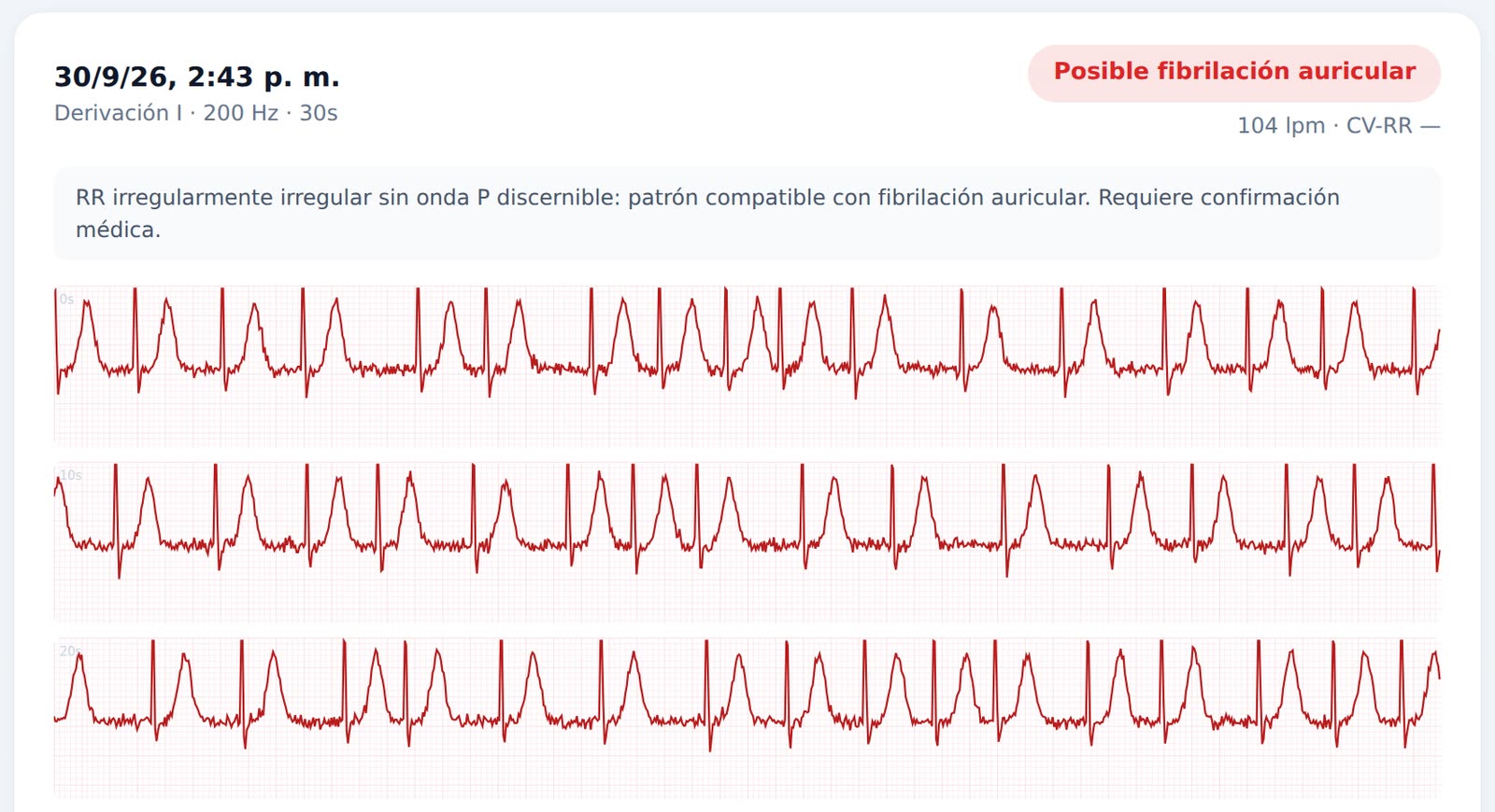 Trazado de ECG de 30 segundos marcado como posible fibrilación auricular: RR irregularmente irregular sin onda P discernible.